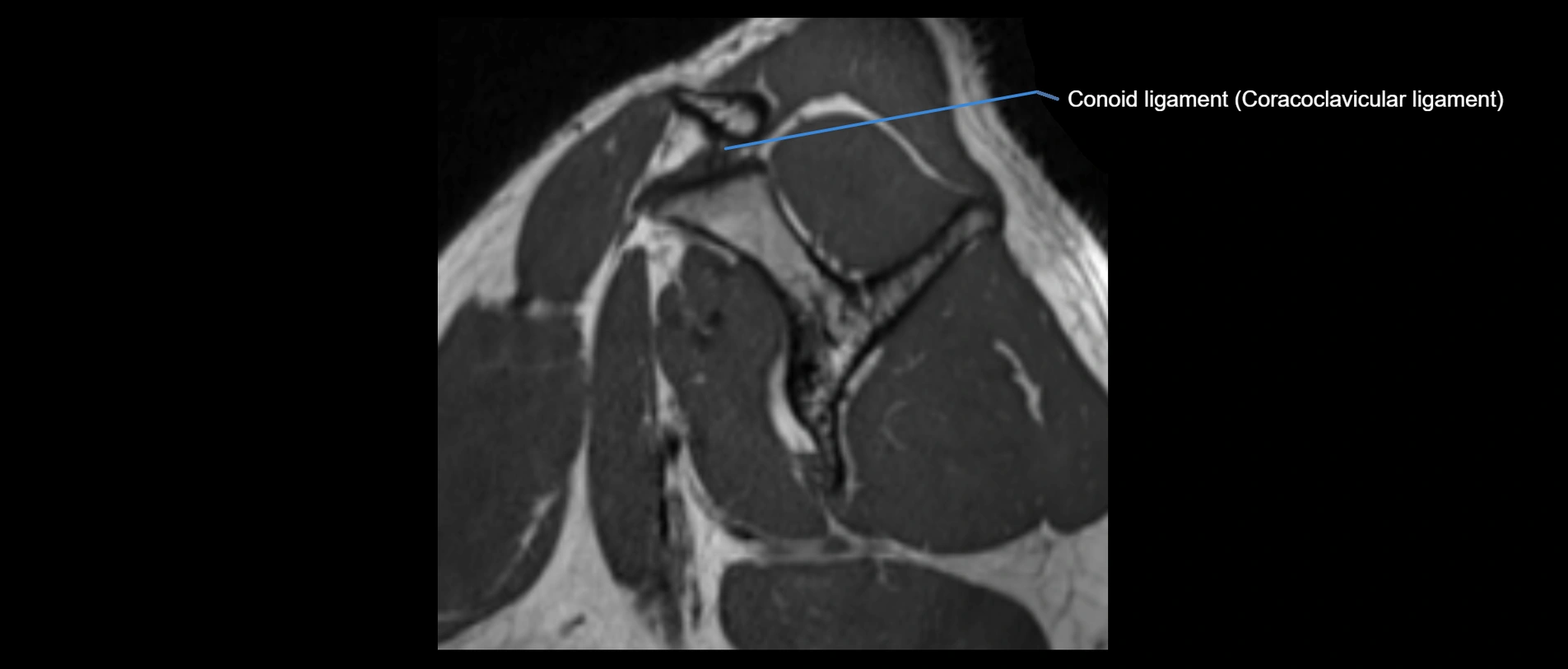 shoulder ligaments sagittal  cross sectional anatomy 3T MRI AI enhanced radiology image -img-00001-00015.webp